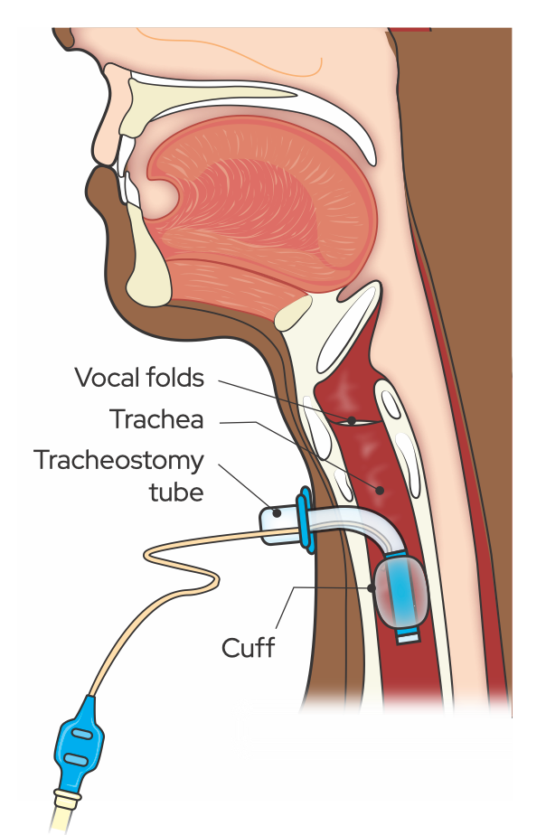 Trach tube in situ